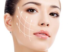 Fili di Trazione per il Viso con Tecnologia Namica Aptos: Ringiovanimento Naturale Senza Bisturi